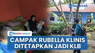 Campak Rubella Klinis Ditetapkan Jadi KLB di Fakfak Papua Barat, Dinkes Gencarkan Vaksinasi ORI