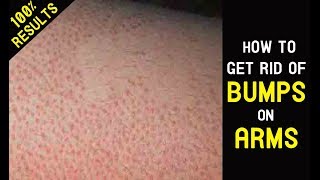 How to Get Rid of Bumps on Arms,Face, Chicken Skin, and Hips||Treatment ||100% Results |