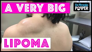 Excision of a Large Lipoma on the Shoulder using Tumescent Technique