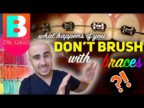 YouTube video about: How do dentists clean teeth with braces?