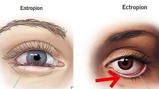 চোখের প্লাস্টিক সার্জারি কেন করা হয়? | Blepharoplasty Surgery