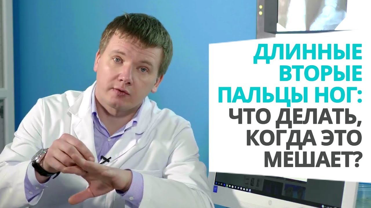 Длинные вторые пальцы ног: что делать, когда это мешает  Доктор Алексей Олейник