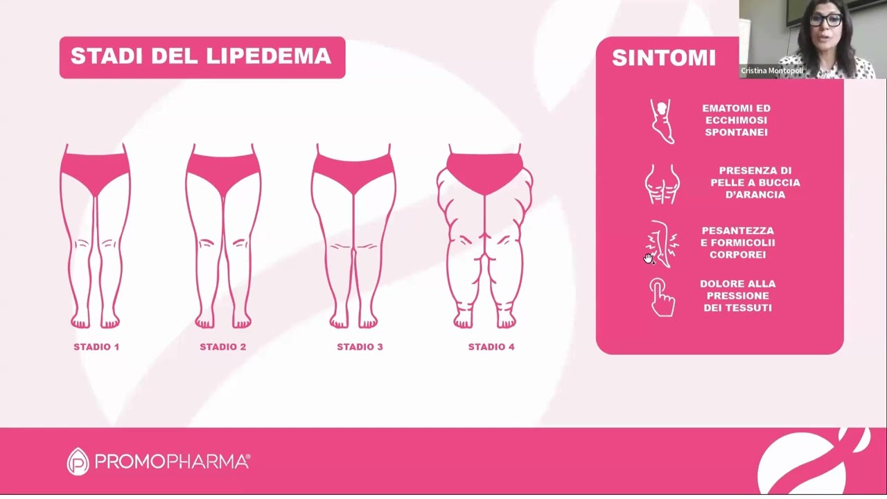  Lipedema e Linfedema: Ricerca e Innovazione nel campo della Nutraceutica