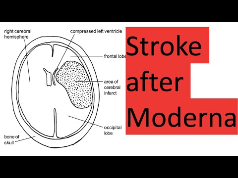 Stroke and worse after Moderna