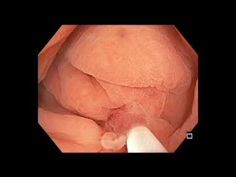 Colonoscopy: Ascending Colon Tethered Polyp - Underwater EMR