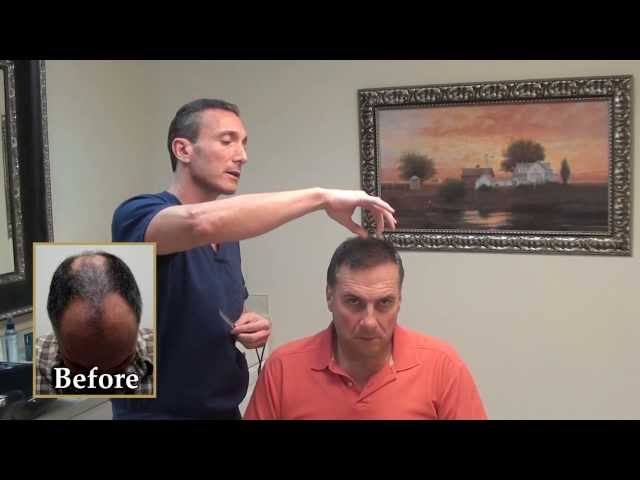 Glenn's Undetectable Scar: 1yr