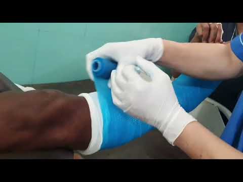 Minimally displaced fracture | Bimaleolar fracture Rt ankle | Conservative Articasting | Adamya Hosp