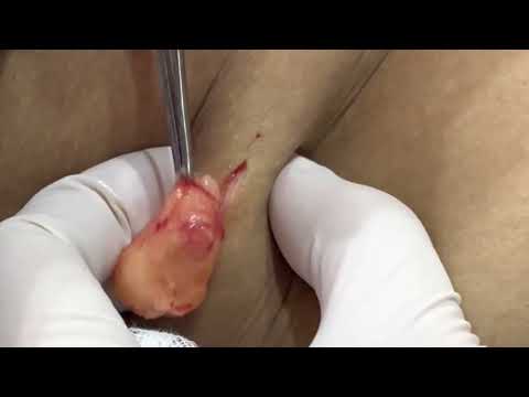Clean removal of a Lipoma