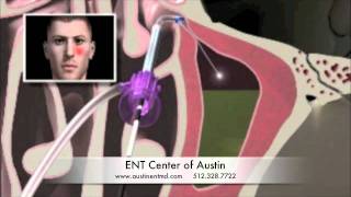 In-Office Balloon Sinuplasty at the ENT Center of Austin