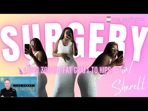Surgery Story: Lipo 360 w/ Fat Grafting to the Hips