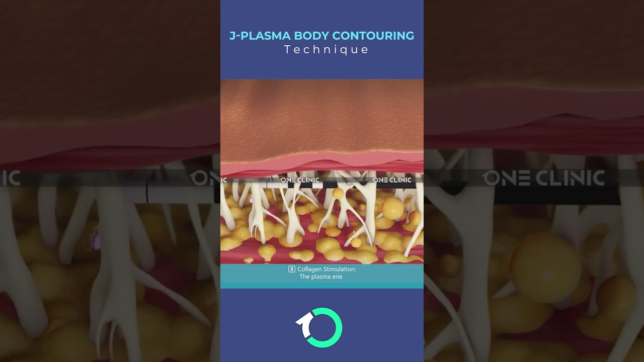 #JPlasma ✨ Instant Skin Tightening in 60 Seconds! | One Clinic Istanbul #oneclinic