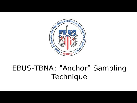 EBUS-TBNA "Anchor" Sampling Technique