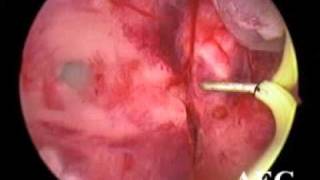preview picture of video 'Dr Rajesh Modi Akola laparoscopic tubal surgery for infertility'