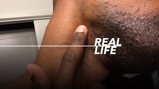 How to make every Ingrown hair go away | Black Men’s Skincare Routine