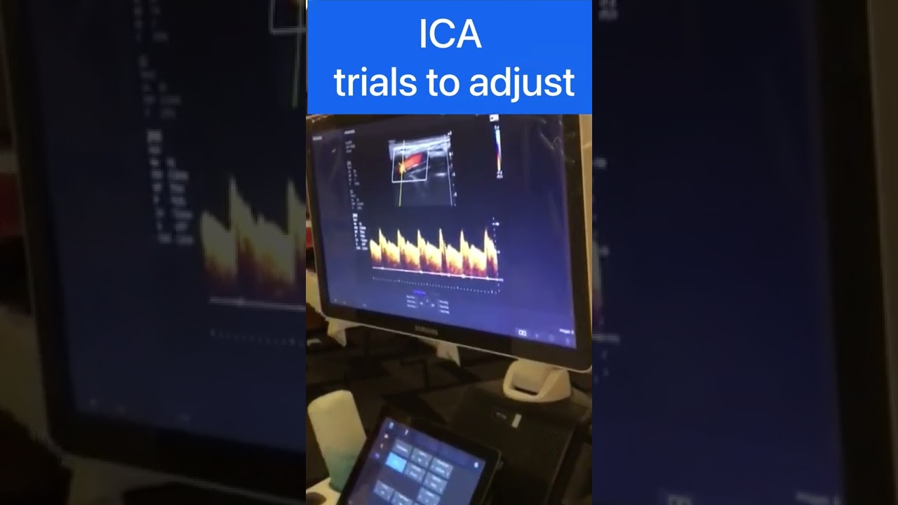 Tip to adjust ICA Doppler tracing | Arabic Version