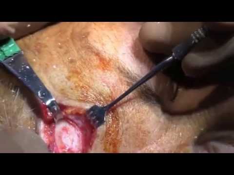 Frontal Bone Osteoma Removal