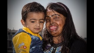 Acid Attack Survivor Finds Love