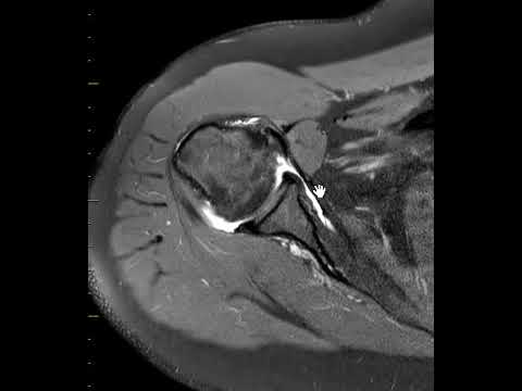 Subscapularis tendon tear and biceps tendon dislocation.