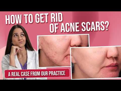 Scars after acne: best acne marks treatment
