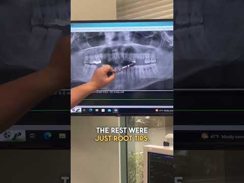 Wait till the end to see the ROOT TIPS 🦷 #dentistry #extractions