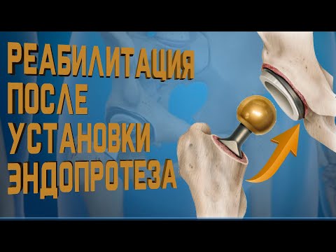 Реабилитация после эндопротезирования. Все что нужно знать! | Доктор Демченко