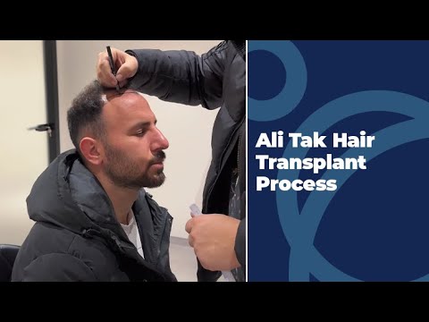 Ali Tak Hair Transplant Process
