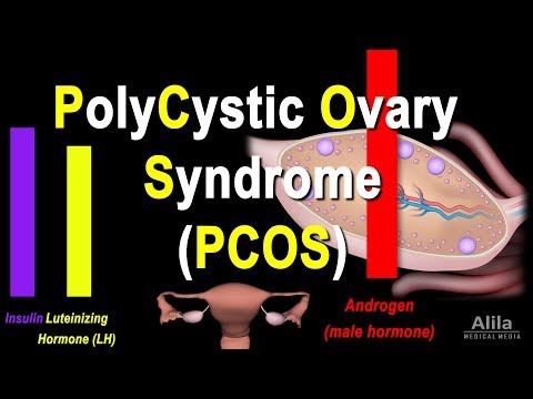 Polycystic Ovary Syndrome (PCOS) Pathology and Treatment, Animation