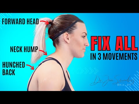I Fixed My Neck Hump And Forward Head Posture In 30 Days!
