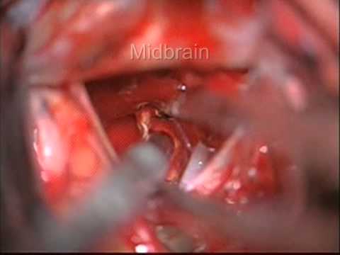 Anterior interhemispheric approach to sellar and suprasellar region