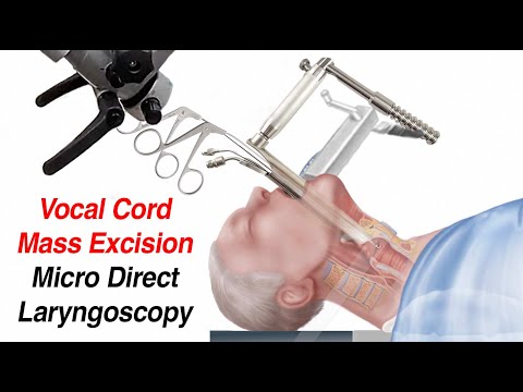 Vocal Cord Surgery Mass Excision - Micro Direct Laryngoscopy