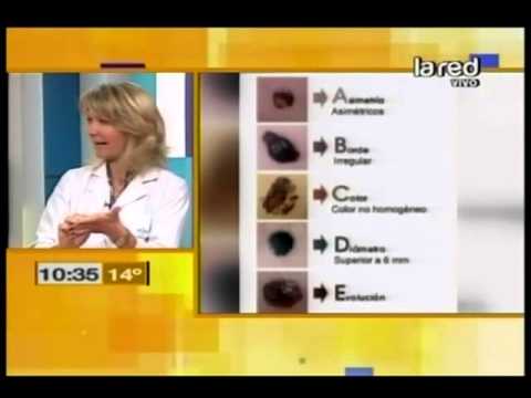 Sepa cómo detectar lunares cancerosos