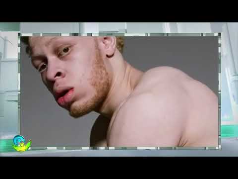 Albinismo Ocular