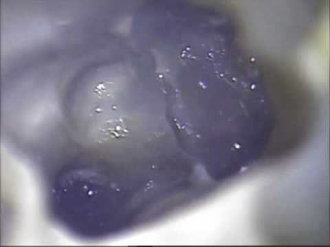 Vertical Tooth Fracture Identified Using Microscope