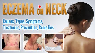 Eczema on neck Causes, Types, Treatment, Prevention and Natural Home Remedies | Neck Dermatitis