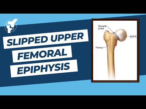 Slipped Capital Femoral Epiphysis