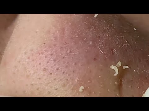 Nose and lips BLACKHEAD smooth extractions