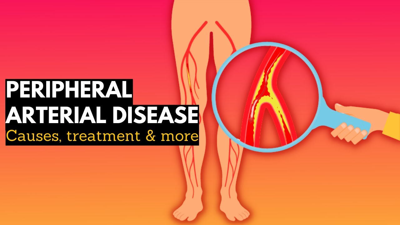 Peripheral vascular disease, Causes, Signs and Symptoms, Diagnosis and Treatment.