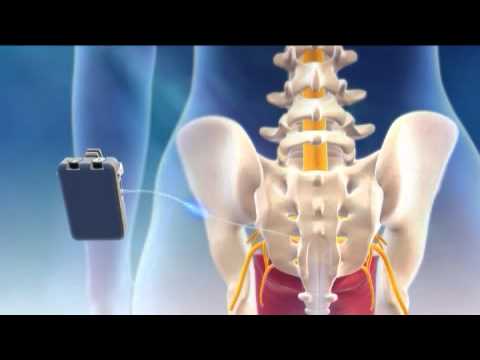 Overview of Sacral Nerve Stimulation for Urinary Control