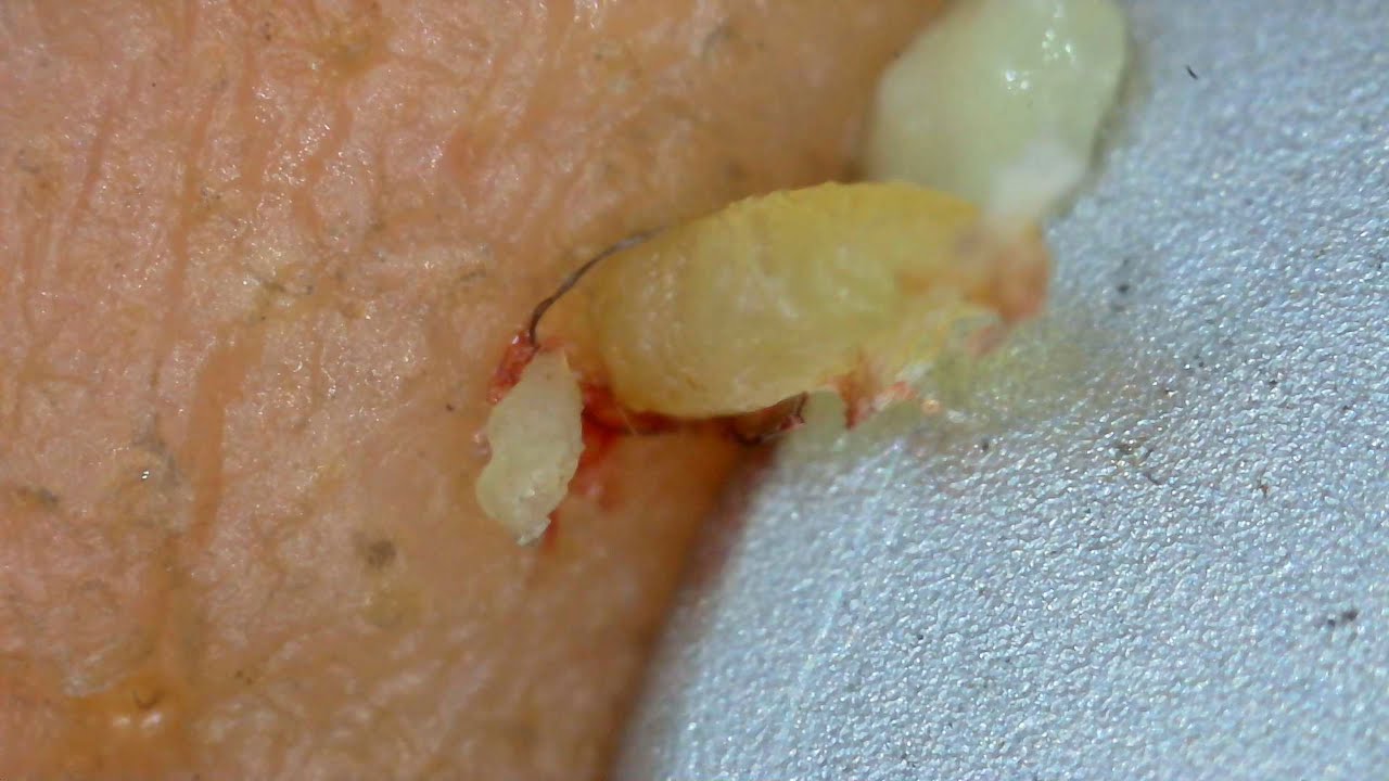 0330 keratin plug removal nose