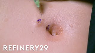 I Got The Belly Button Piercing Removal Surgery | Macro Beauty | Refinery29