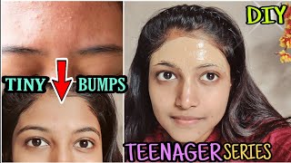 Treat Forehead TINY BUMPS Naturally at home😍 1 week Challenge