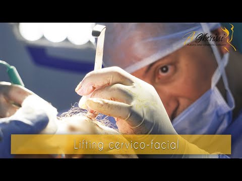 Vidéo d'un lifting cervico-facial et temporal avec une blépharoplastie 4 paupières par le Dr Anas Gherissi