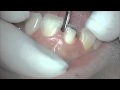 Tooth preparation for All-ceramic crown 