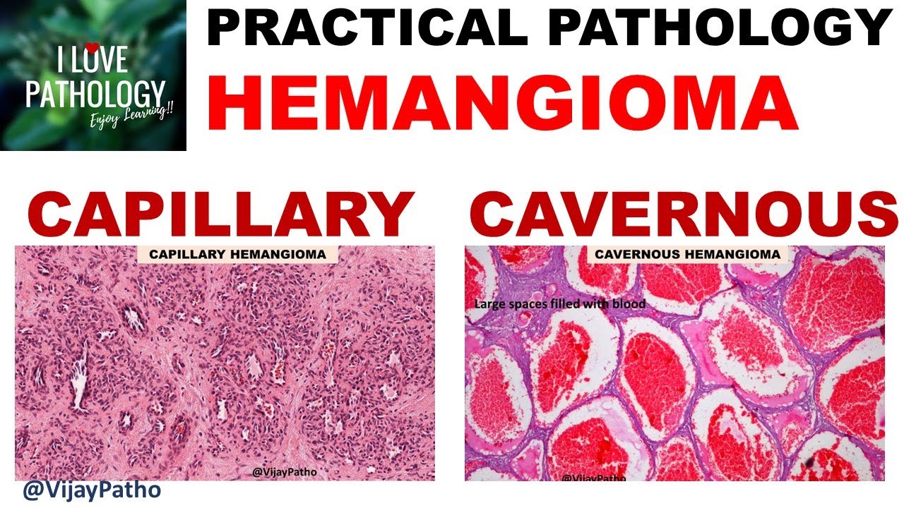 HEMANGIOMA: capillary & Cavernous. Clinical features & Morphology