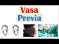 Vasa Previa (Obstetrical Condition) | Causes, Risk Factors, Signs & Symptoms, Diagnosis, Treatment