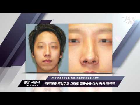 국원석성형외과 매부리코 재수술 사례