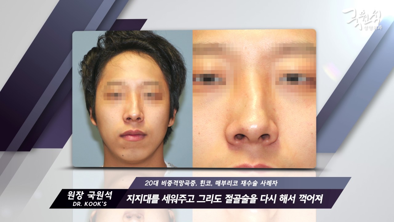 국원석성형외과 매부리코 재수술 사례