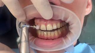 Blanqueamiento Dental - Procedimiento paso a paso - Abaden Dentistas Tarragona