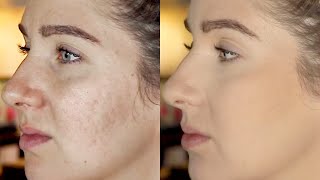 Pitted Acne Scar Makeup Tutorial Step by Step ( Icepick Scars/Boxcar Scars/Craters/potmarks