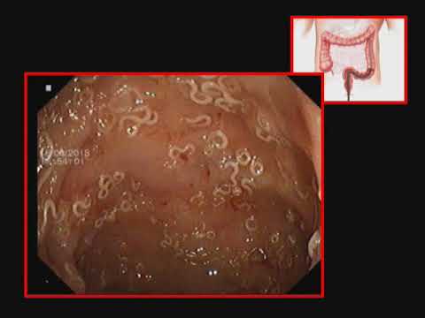 trichocephalosis laboratóriumi diagnózis)